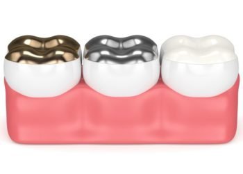Dental Crowns Are Gaining Prominence – The Essential Benefits to Count On