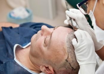 What makes Turkey top choice for hair transplants in Europe