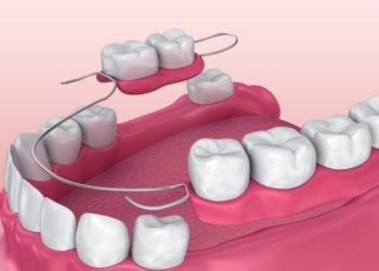 Exploring What Partial Dentures do and Their Benefits