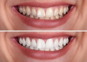 More People are Saying Yes to Teeth Whitening Treatment – Tune in to the Crucial Benefits