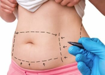 Getting A Tummy Tuck Fat Removal Surgery in Singapore? Here’s What To Expect