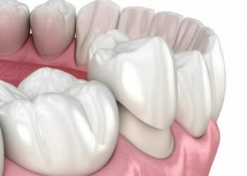 Do you need a dental cap or a dental crown? Know more!