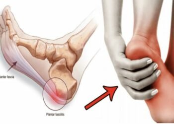 Identifying the symptoms of plantar fasciitis on time prevents the pain from getting worse!