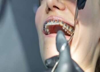 Take Control of Your Smile With the Help of Metal Braces