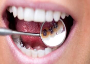 Invisalign vs. Traditional Braces: Which is the Right Choice for You?