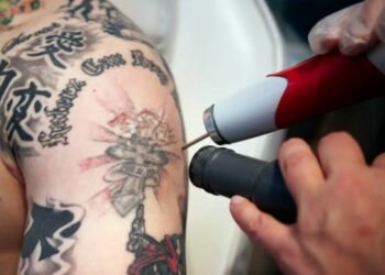How Tattoo Removal Services in Vancouver Are Changing Lives 