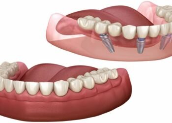 The Cost of Full Mouth Dental Implants: Breaking Down the Expenses