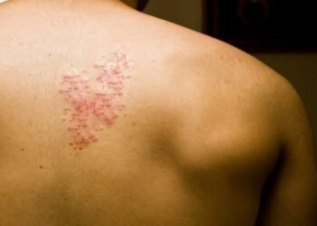 What Is Shingles? Everything You Need to Spot and Treat This Condition