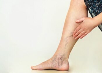 Understanding Your Options: Different Types of Varicose Vein Treatment Near Me