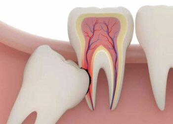 Third Molar Removal: Do’s and Don’ts