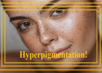 Best Ways to Treat Hyperpigmentation