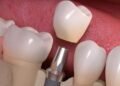 Single Tooth to Full Smile: Dental Implant Options in Brisbane