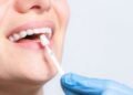 How Do Dentists Prepare Teeth for Porcelain Veneers in Brisbane?